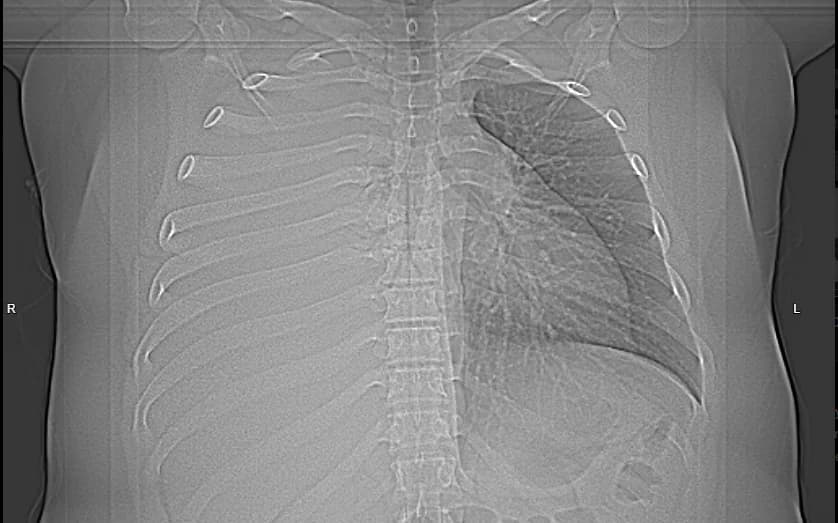 Radiografía de tórax con velamiento del hemitórax derecho