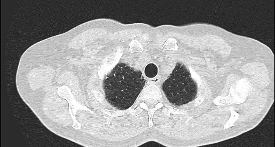 Corte axial de tomografía de tórax